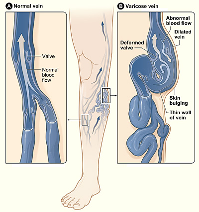 varicose veins legs image